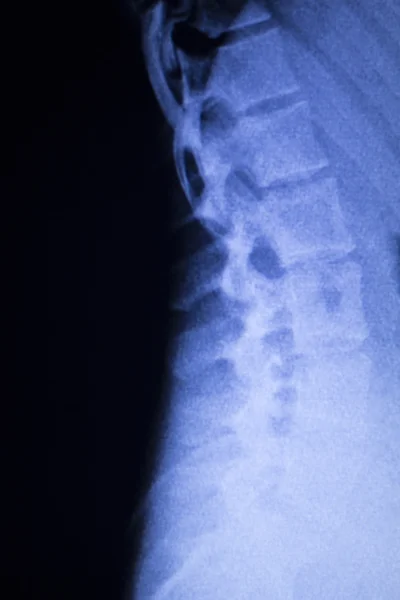 Spine vertebra back injury xray scan — Stock Photo, Image