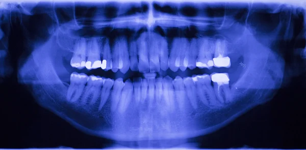 Escaneo de rayos X de dentistas de relleno dental —  Fotos de Stock