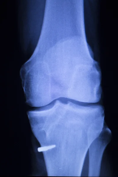 Rastreamento de raio x de implante de parafuso de lesão do joelho — Fotografia de Stock