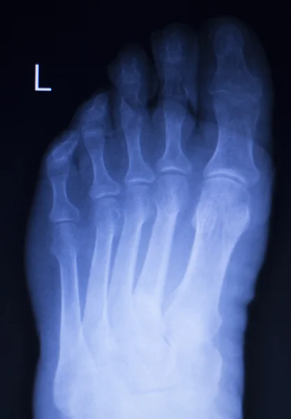 Τα πόδια και τα δάχτυλα των ποδιών τραυματισμό xray σάρωση — Φωτογραφία Αρχείου