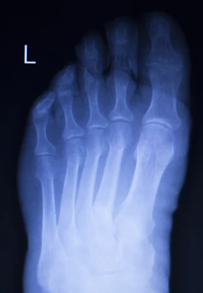 Foot and toes injury xray scan — Stock Photo, Image