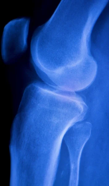 Lesión de rodilla y menisco Tomografía de rayos X — Foto de Stock