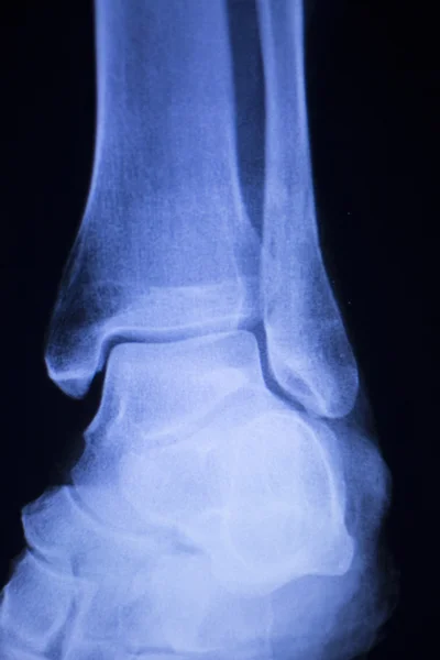 Shin láb boka sérülések xray scan — Stock Fotó