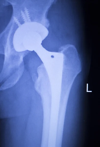 Radiografía de reemplazo de cadera exploración médica ortopédica —  Fotos de Stock