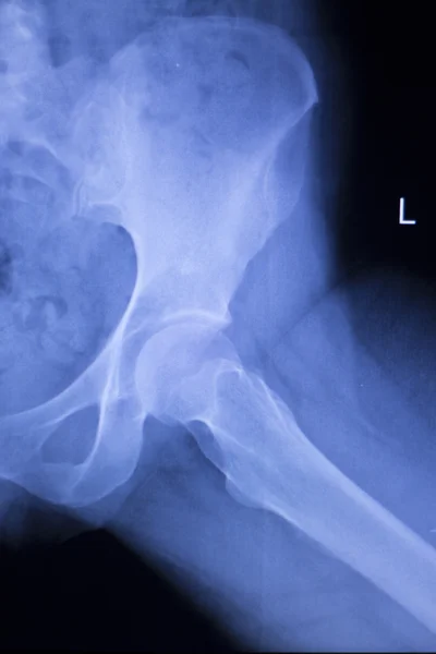 Медичне сканування рентгенівської травми кульшового суглоба — стокове фото