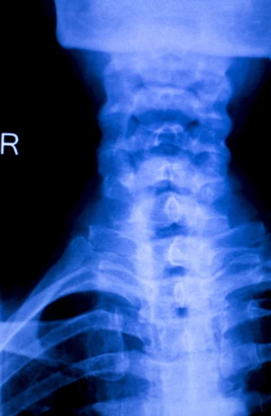 Skull neck spine xray scan — Stock Photo, Image