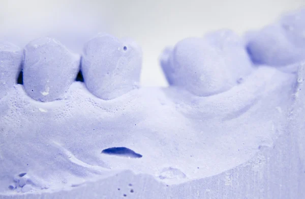 Protetyka stomatologiczna gliny ząb formy — Zdjęcie stockowe