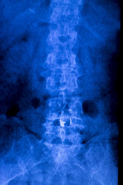 Рентген спины позвоночника — стоковое фото