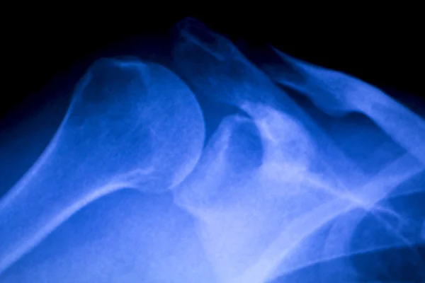 Hip injury xray medical scan