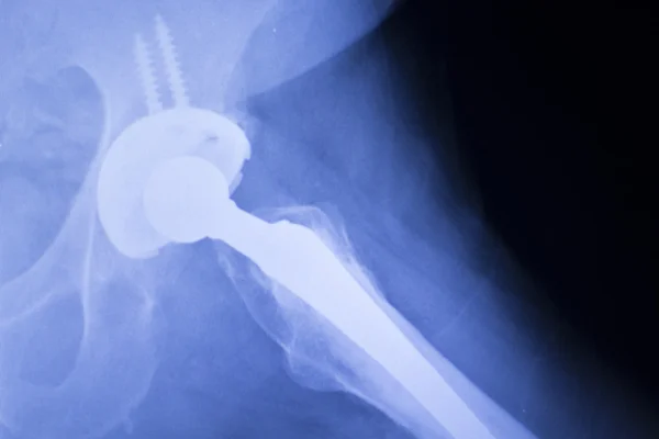 Hip replacement xray orthopedic medical scan — Stock Photo, Image