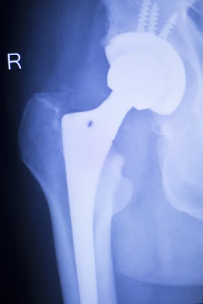 Radiografía de reemplazo de cadera exploración médica ortopédica — Foto de Stock
