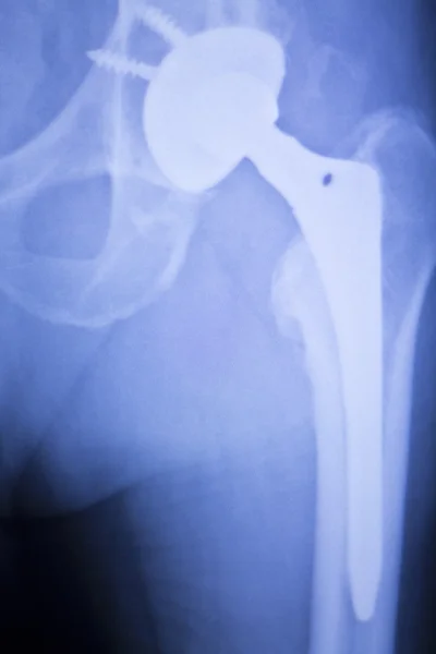 Hip replacement xray orthopedic medical scan