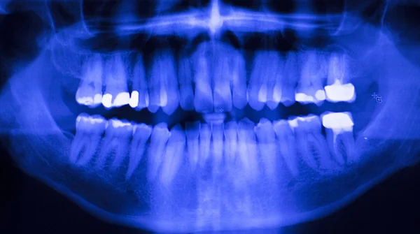 Dental teeth filling dentists xray scan — Stock Photo, Image