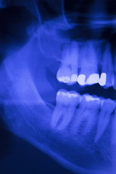 Escaneo de rayos X de dentistas de relleno dental — Foto de Stock