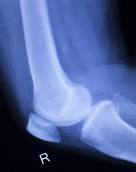 Röntgenbild einer Knie- und Meniskusverletzung — Stockfoto