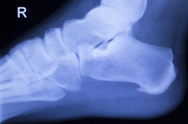 Foot heel ankle injury xray scan