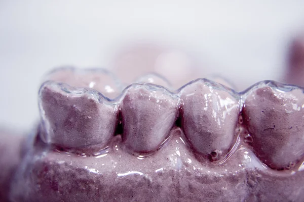 Tandheelkundige protheses klei tand schimmel — Stockfoto