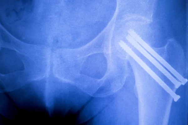 Hip replacement xray orthopedic medical scan