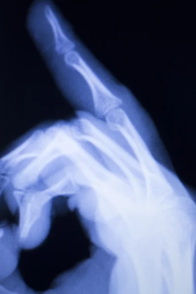 Mão dedos polegar pulso xray varredura — Fotografia de Stock