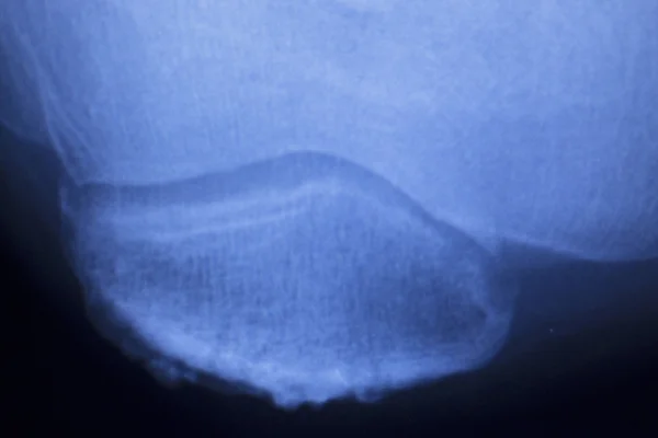 Térd- és meniscus sérülés xray scan — Stock Fotó