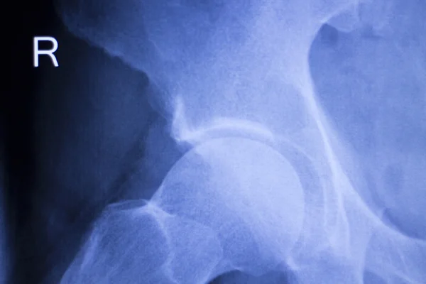 Röntgenbild der Hüftverletzung — Stockfoto
