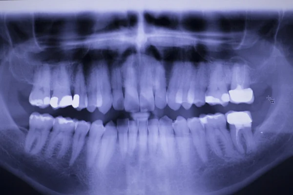 Рентген зубов стоматолога — стоковое фото