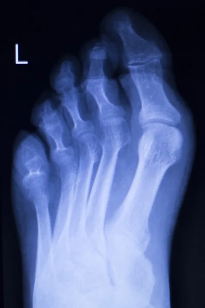 Τα πόδια και τα δάχτυλα των ποδιών τραυματισμό xray σάρωση — Φωτογραφία Αρχείου