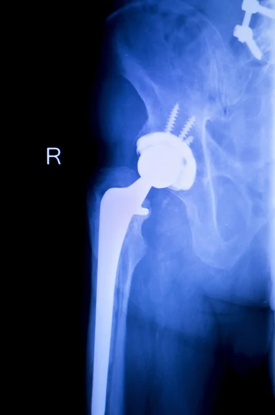 Ортопедическое сканирование на замену бедра — стоковое фото