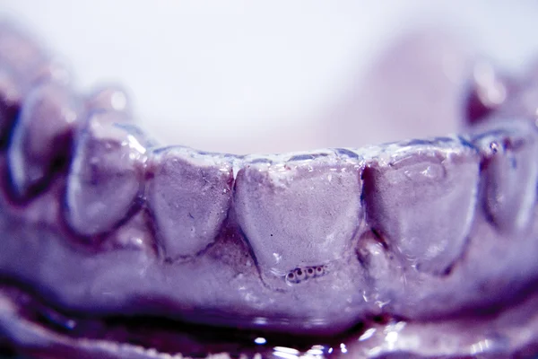 Próteses dentárias molde de argila dente — Fotografia de Stock