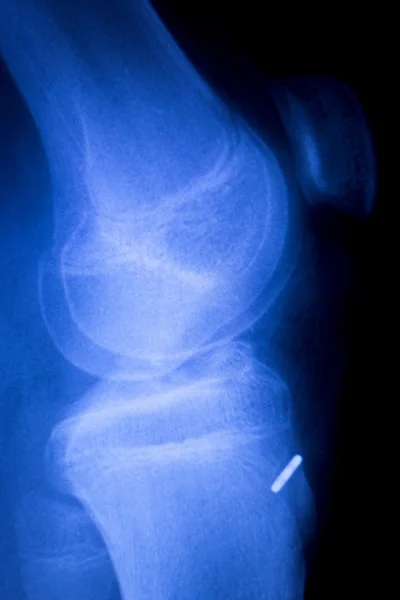 Genou blessure vis implant radiographie — Photo