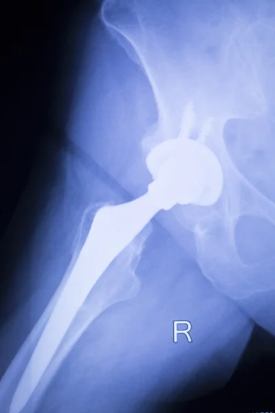 Hip replacement xray orthopedic medical scan — Stock Photo, Image