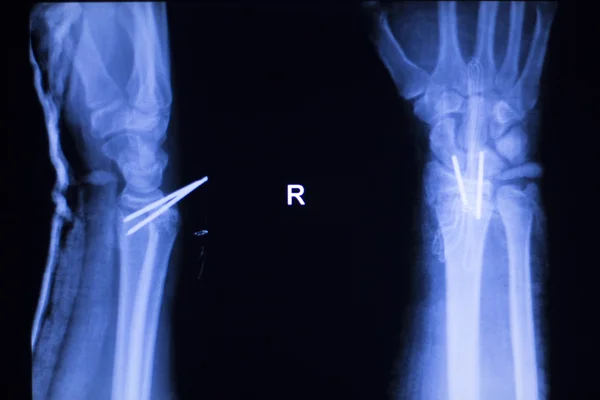 Antebraço implantes ortopédicos xray scan — Fotografia de Stock