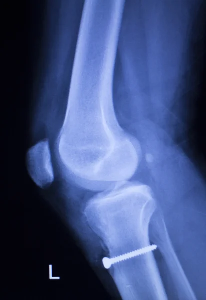 Exploración por rayos X de implante de tornillo de lesión de rodilla — Foto de Stock