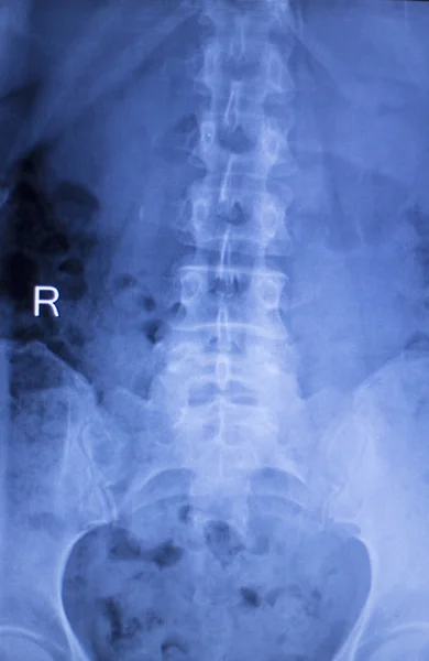 척추 척추 허리 부상 엑스레이 검사 — 스톡 사진