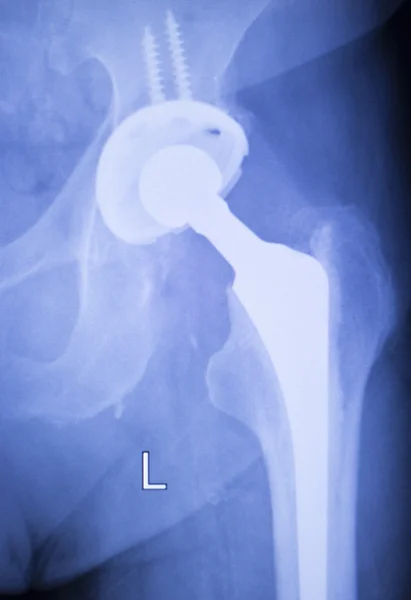 Hip penggantian xray ortopedi scan medis — Stok Foto