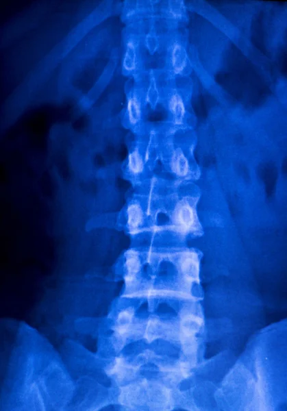 Spine vertebra back injury xray scan — Stock Photo, Image