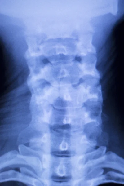 颅颈脊柱肩 x 射线扫描 — 图库照片