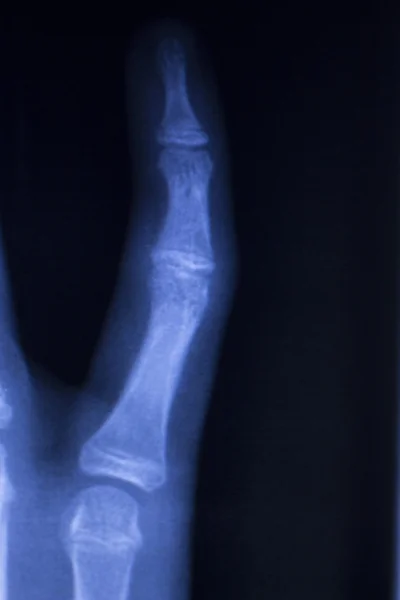 Сканування рентгенівських пальців рук — стокове фото