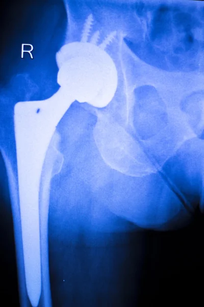 Заміна кульшового рентгенівського ортопедичного медичного сканування — стокове фото