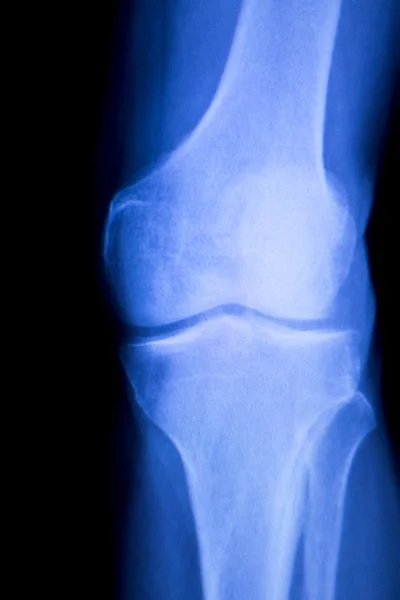 Knie en de meniscus letsel xray scan — Stockfoto