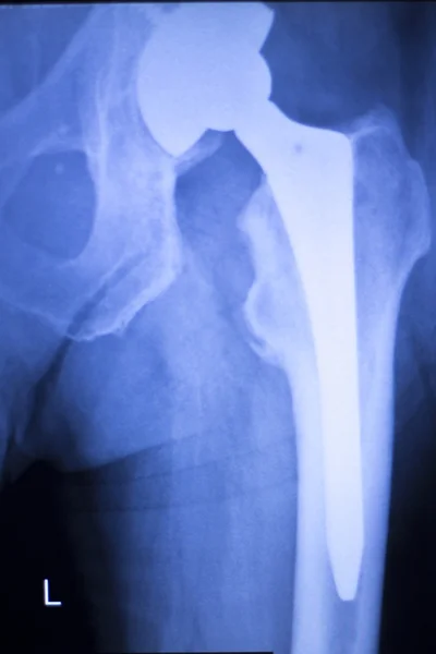 Імплантат ортопедичної заміни кульшового суглоба — стокове фото