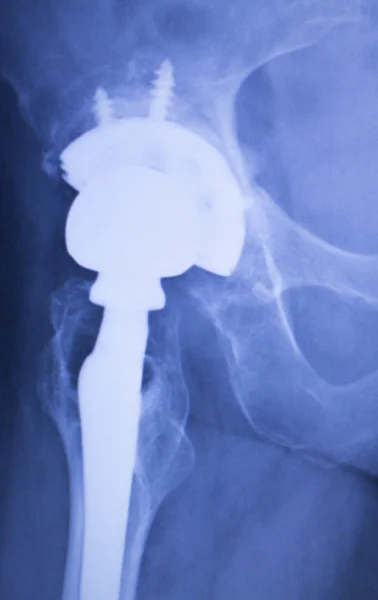 Hip replacement xray orthopedic medical scan