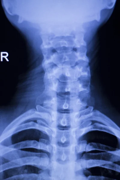 Schädel Hals Wirbelsäule Schultern Röntgenbild — Stockfoto