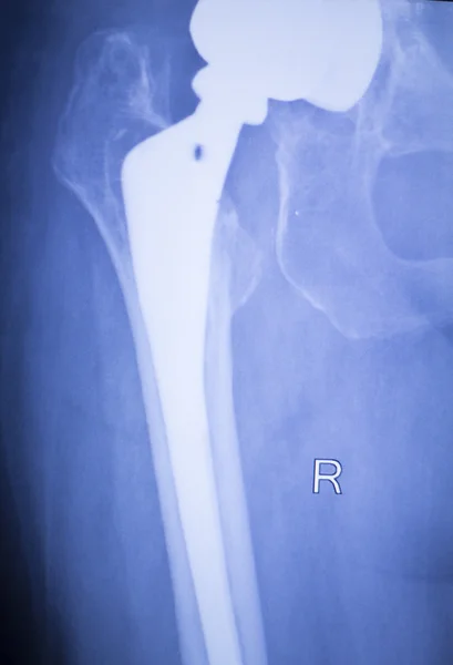 Hanche remplacement radiographie orthopédique balayage médical — Photo