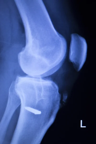 Genou blessure vis implant radiographie — Photo