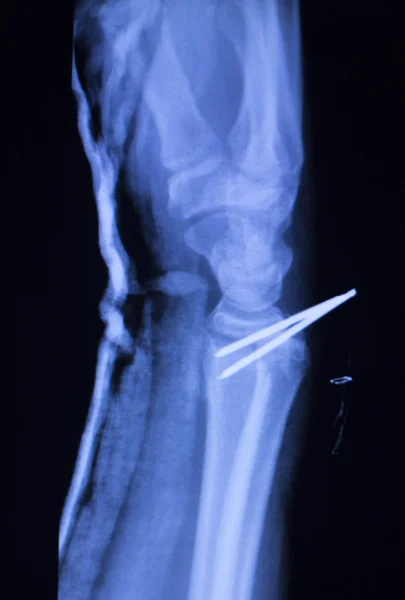 前臂矫形植入 x 线扫描 — 图库照片