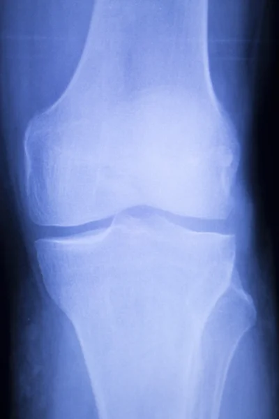 Lesión de rodilla y menisco Tomografía de rayos X — Foto de Stock