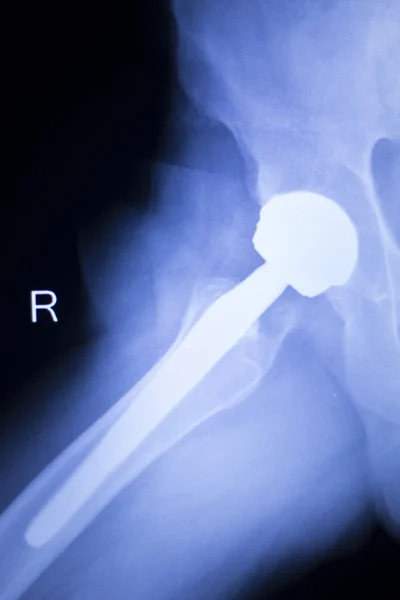 Hip replacement xray orthopedic medical scan — Stock Photo, Image