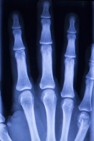 Ручне сканування зап'ястя рентгенівського пальця рук — стокове фото