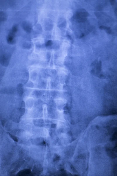 脊柱椎体背伤 x 射线扫描 — 图库照片